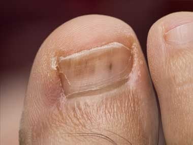 Red spot on pinky toe swollen - Doctor answers on ...