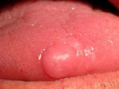 When should you see a doctor for the burning tongue disease?