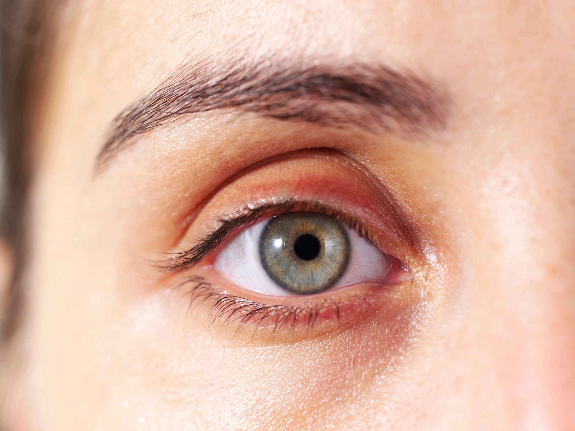 What does dry skin around the eyes indicate?