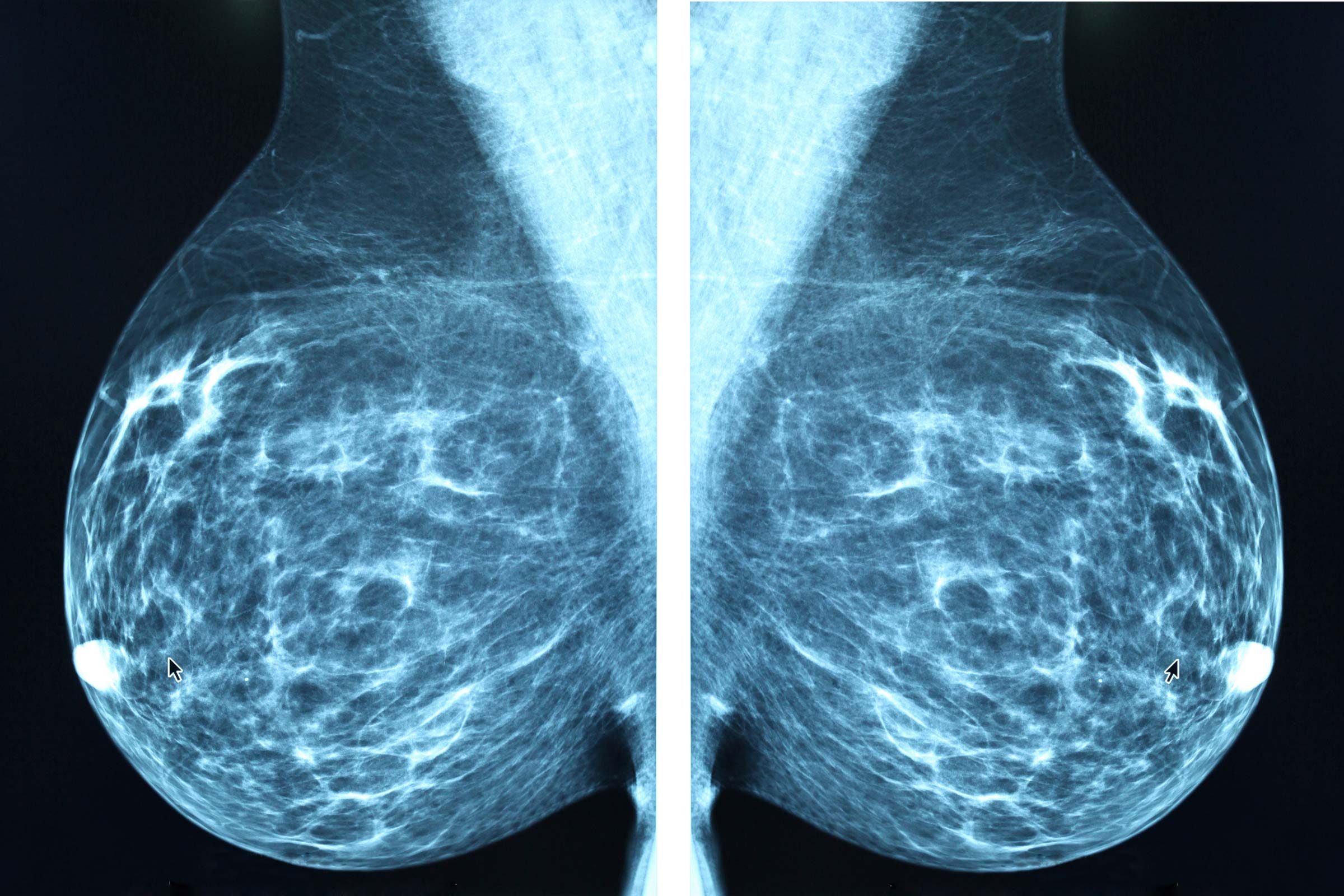 What happens after you get an abnormal mammogram?