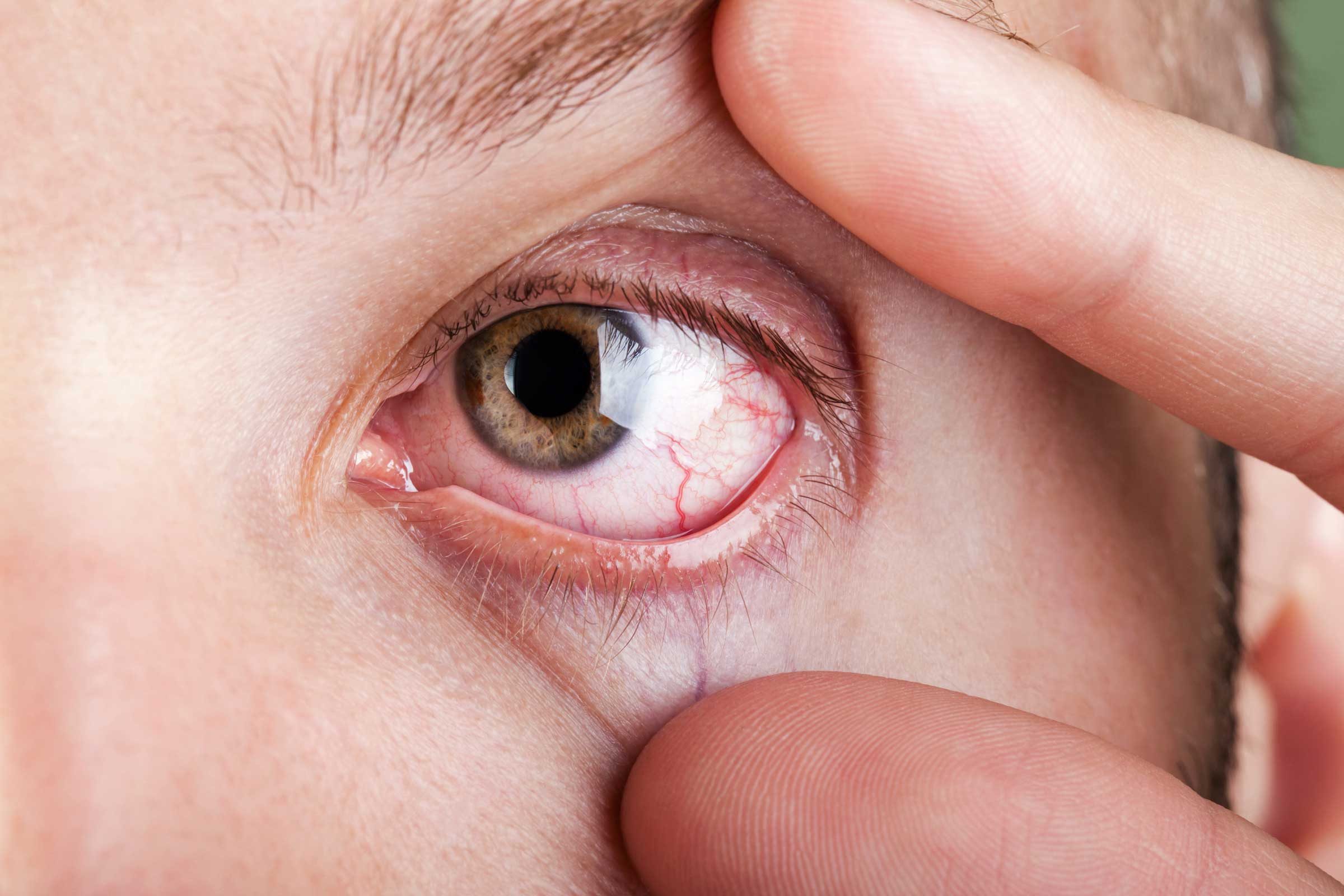 How do you know if you have pink eye?