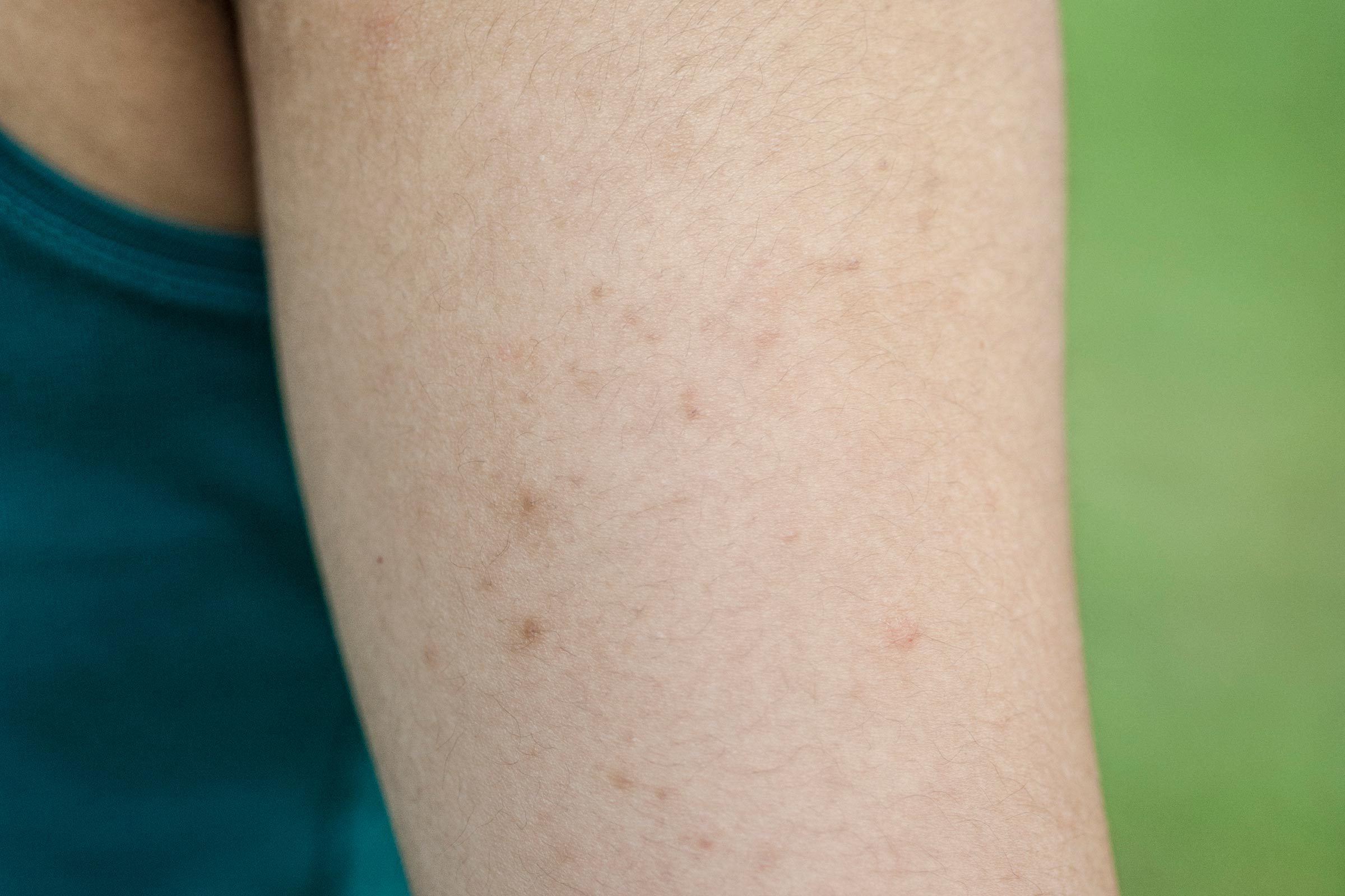 What causes small pimples on the arms?