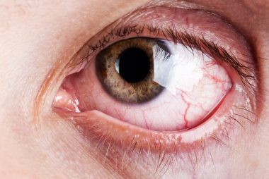 What causes red, bloodshot eyes?