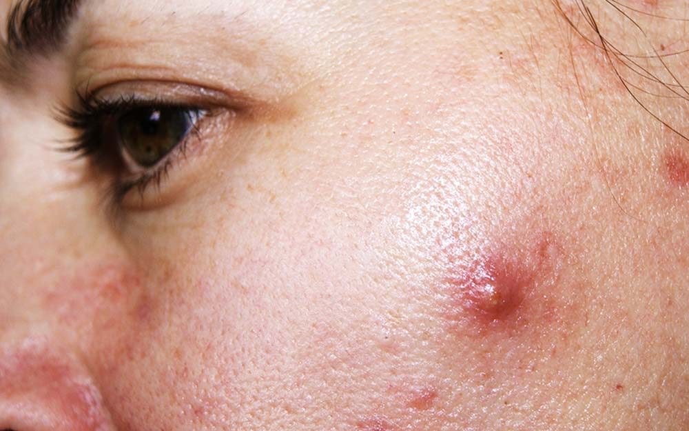 01-cystic-acne-How-To-Get-Rid-of-Cystic-Acne-Overnight_599026772-vialik-ft.jpg (1000×625)