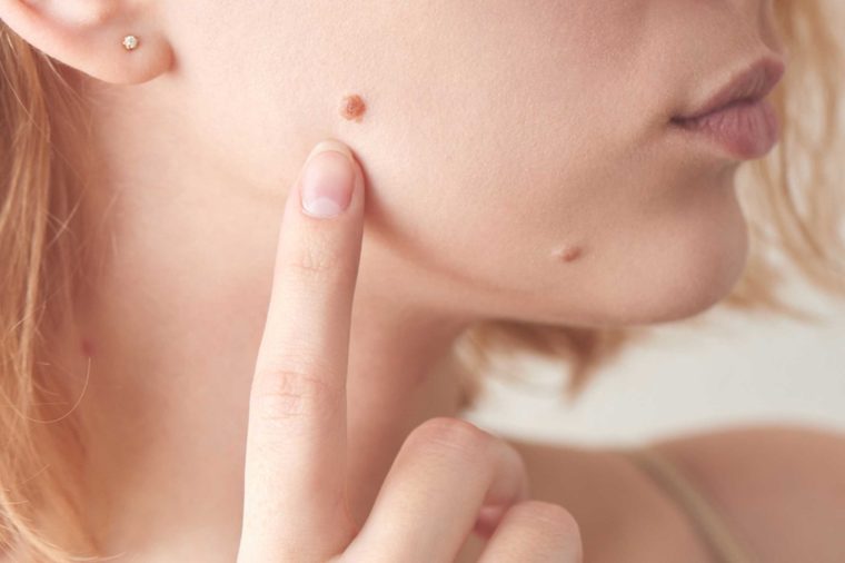08-mole-Things-You-Must-Never-Ever-Do-to-Your-Skin,-According-to-Dermatologists_627456836-amixstudio