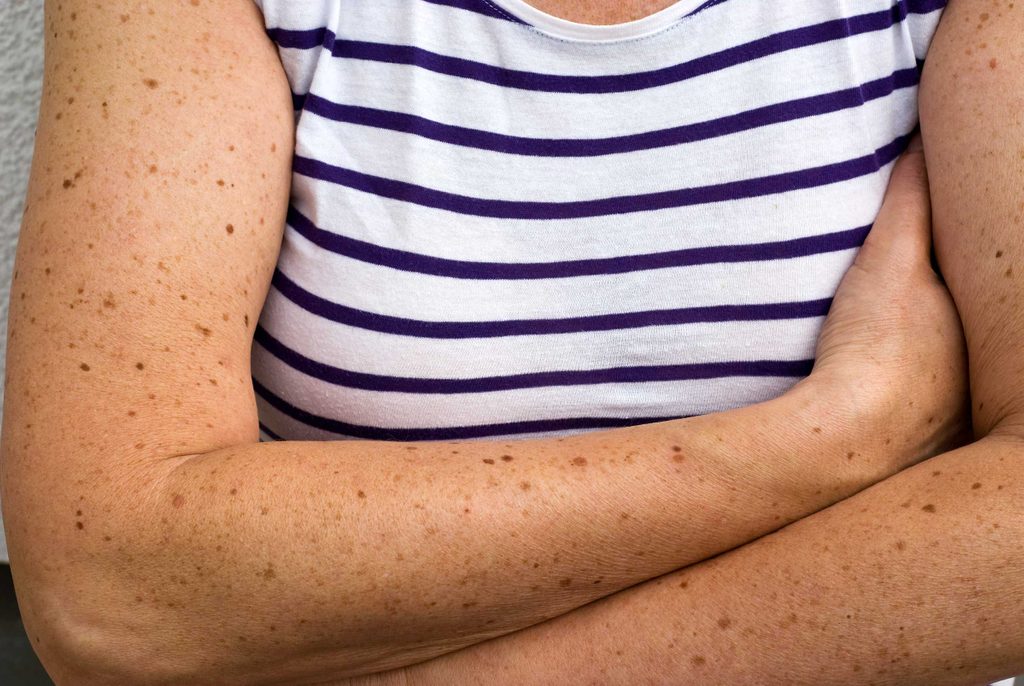 health tips moles on arm