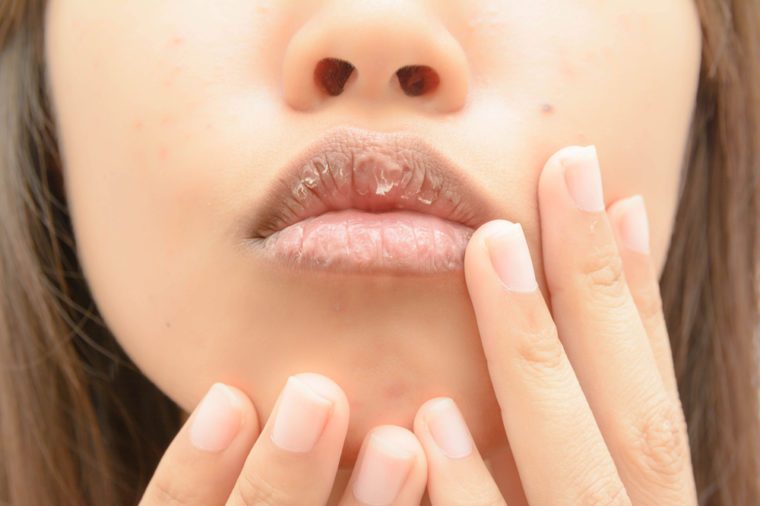 Image result for skin lips winter