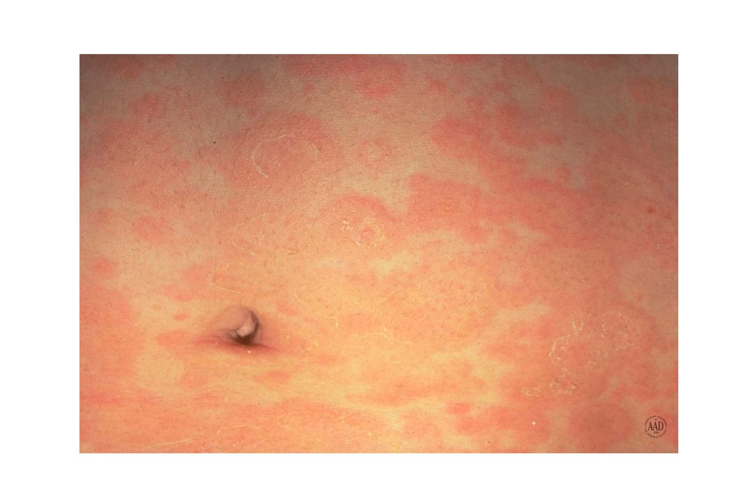 Pityriasis rosea on the stomach