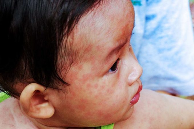 Are-Measles-Coming-Back--What-You-Need-to-Know