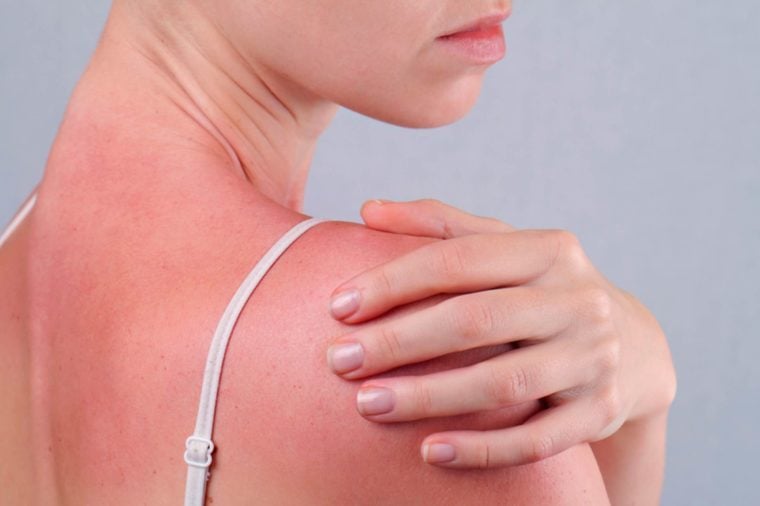 woman's sunburned shoulder