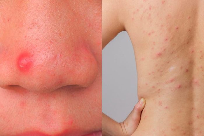 00-opener-What-The-Acne-On-Every-Part-Of-Your-Body-Is-Trying-To-Tell-You-shutterstock