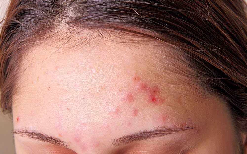 Severe body acne