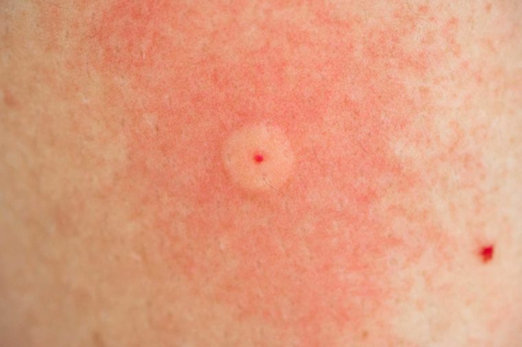 Mosquito Bites Vs Bed Bug Bites Pictures Bed Bug Get Rid