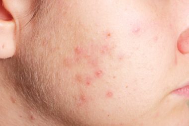 What Your Acne Says About Your Health | Reader's Digest