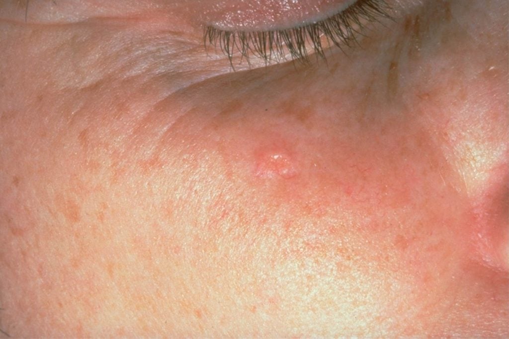 person with redness and bumps on bridge of nose (Sebaceous hyperplasia)