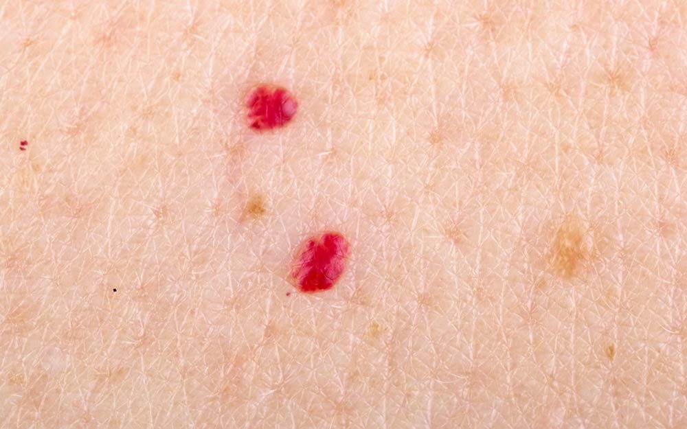 How To Remove Cherry Angiomas Red Moles Readers Digest