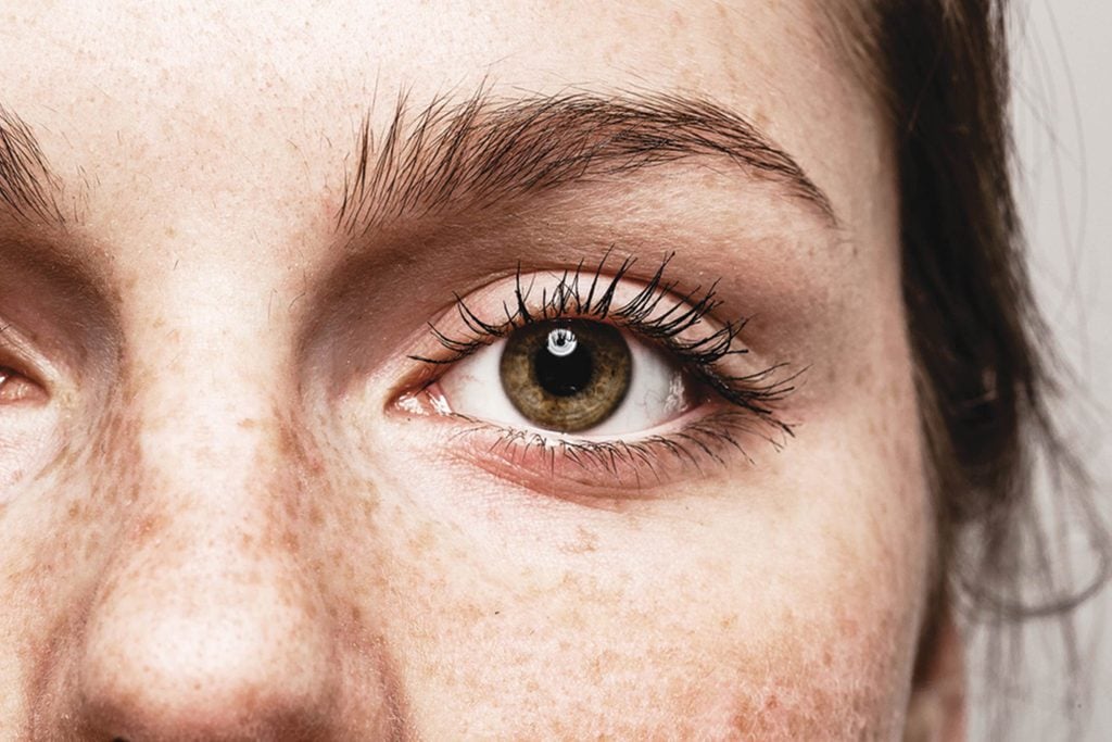 What-Eye-Freckles-Reveal-About-Your-Health