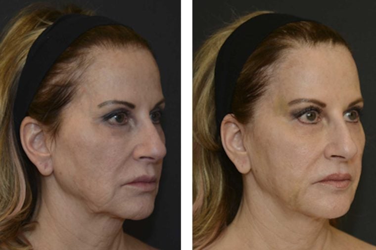 Are Thread-Lifts the New Face-Lift? What You Need to Know About This New Procedure