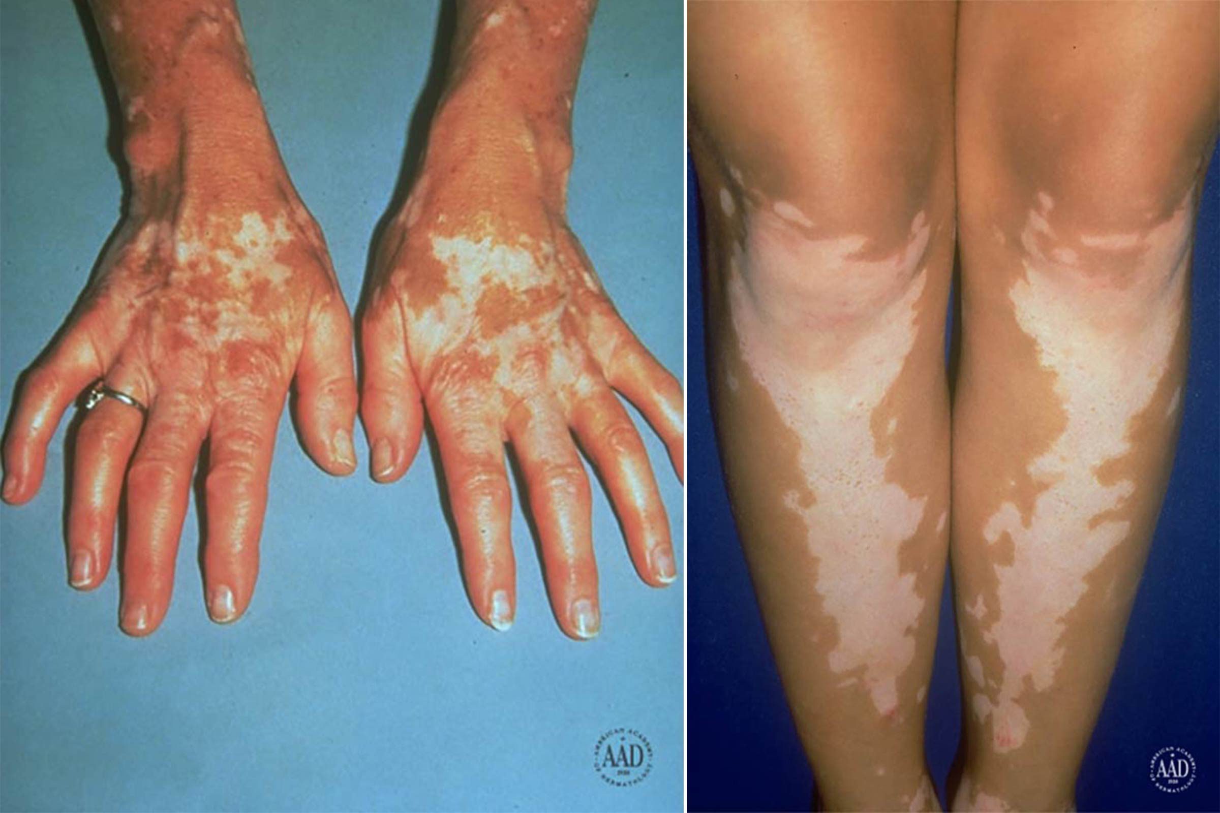 How To Get Rid Of White Spots On Legs 81