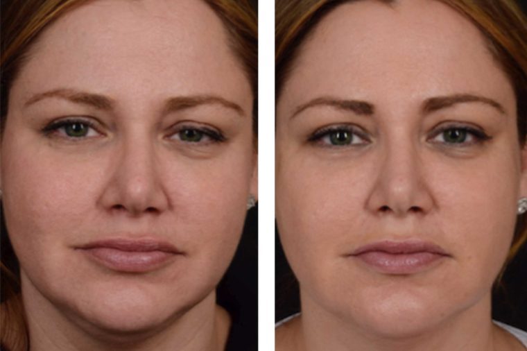 Are Thread-Lifts the New Face-Lift? What You Need to Know About This New Procedure