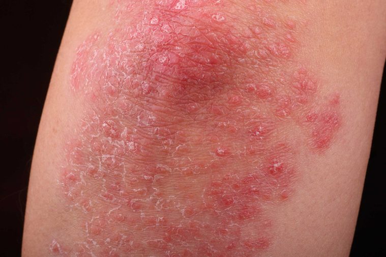 Common Conditions that Affect Men and Women Differently13-psoriasis-shutterstock_554534830-Quayside