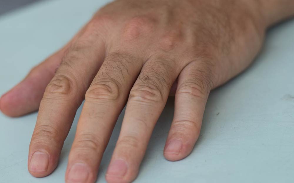 This Specific Fingernail Mark Could Signal Melanoma ...