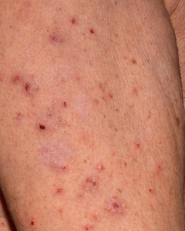 Bug Bite Symptoms You Should Never Ignore The Healthy