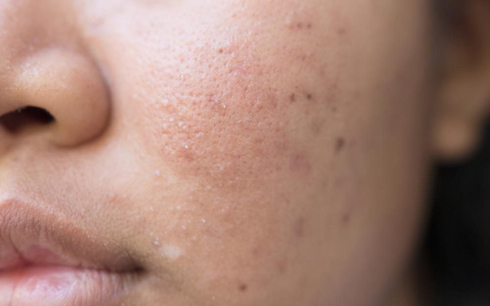 Bad Habits That Make Acne Scars Worse