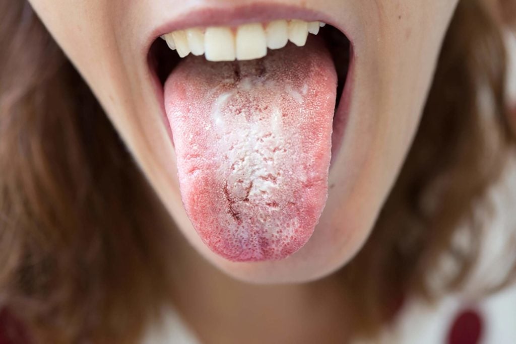 Candidiasis In The Mouth 19