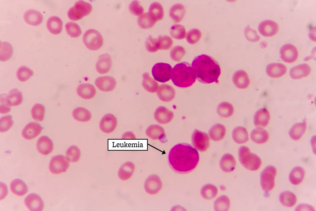 leukemia