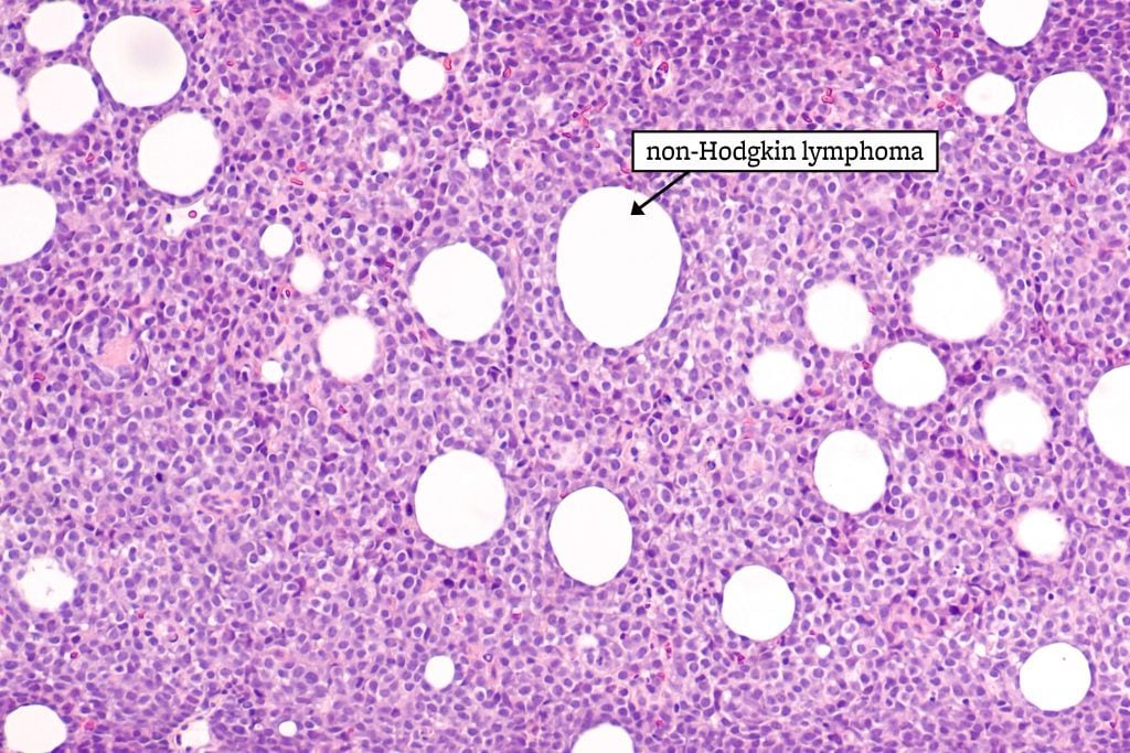 non-Hodgkin lymphoma
