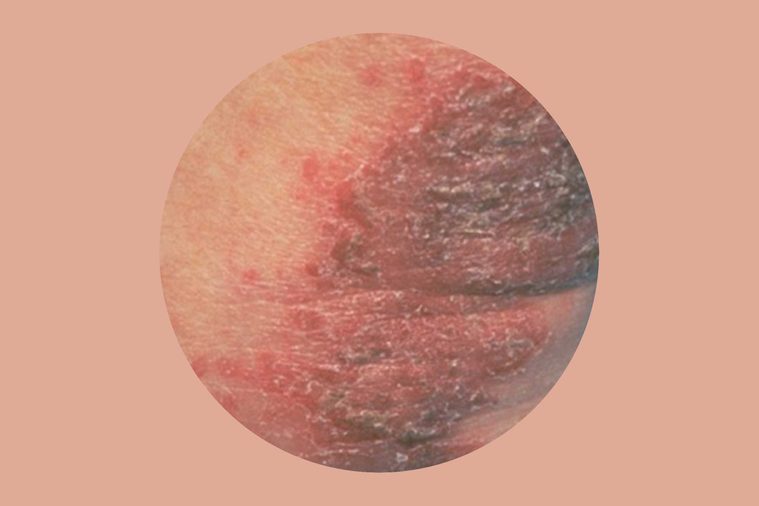 nummular eczema