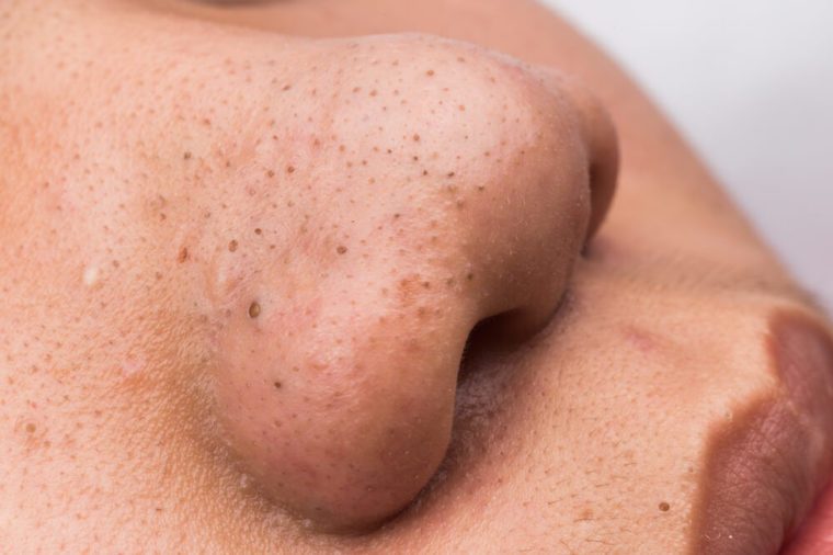 The Surprising All-Natural Ingredient You Need to Get Rid of Blackheads