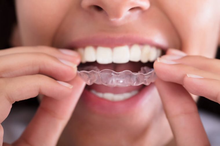 Close-up Of Woman's Hand Putting Transparent Aligner In Teeth