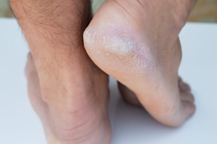 closeup on dry dehydrated skin on the heels of male feet with calluses
