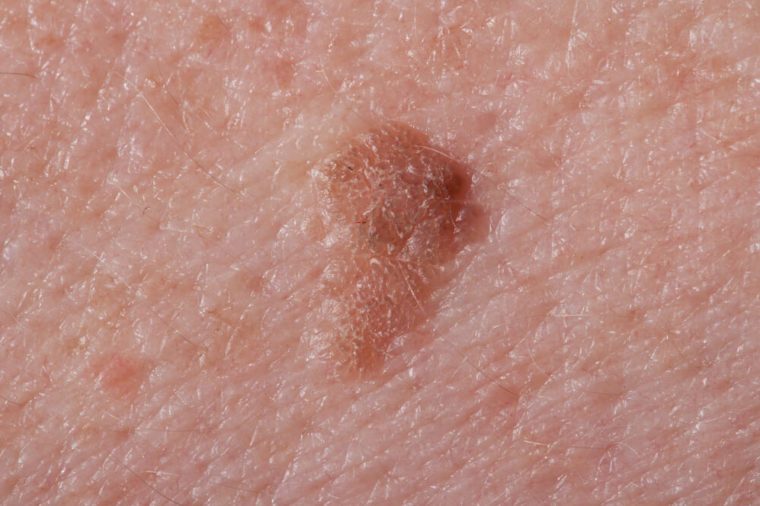Liver spot on the skin of an old person