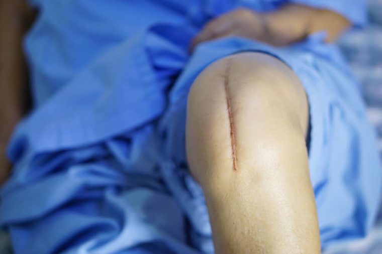 Asian senior or elderly old woman patient show her scars surgical knee surgery on the bed in hospital.