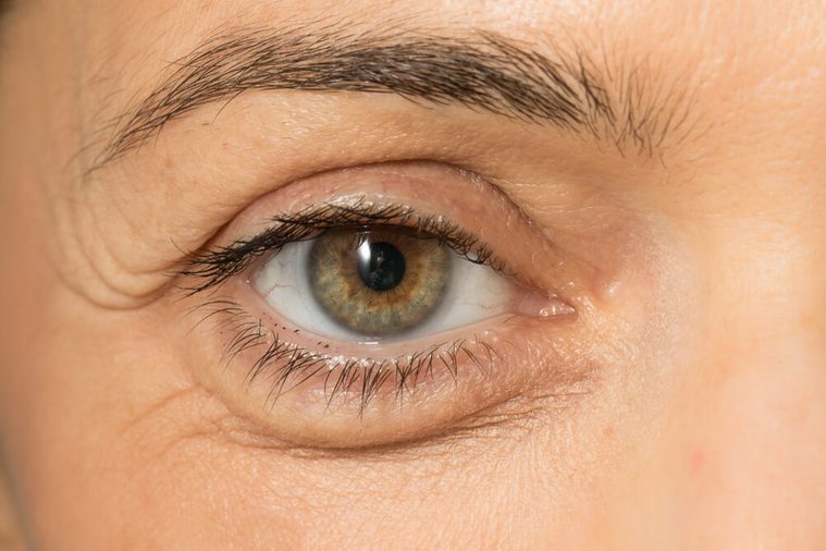 eye bags close up on woman face