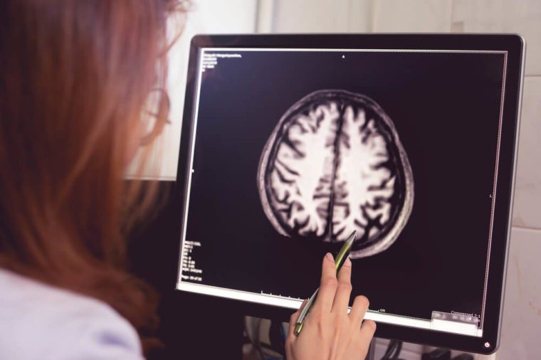 MRI brain of Dementia patient with left parietal atrophy asymmetry