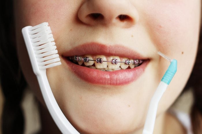 Teenage girl with the braces on her teeth is smiling,portrait of teen girl showing dental braces and toothbrush for braces
