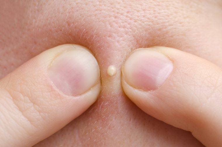 squeezing pimple macro