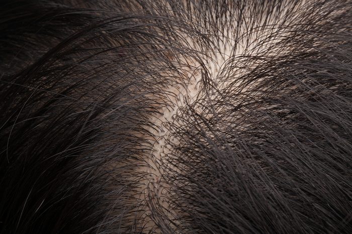 Closeup head with thinning hair and scalp