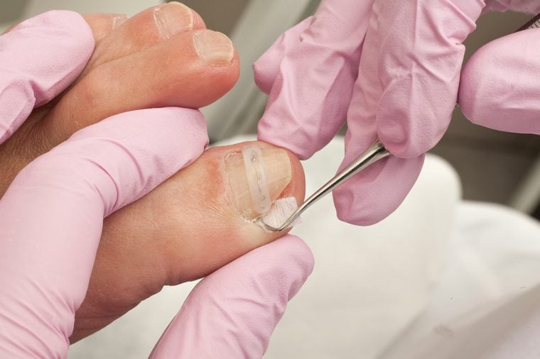 Doctor Podiatry removes calluses, corns and treats ingrown nail. Hardware manicure. Concept body care.