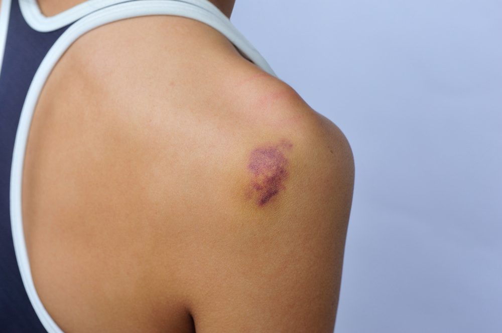 bruise on woman's shoulder