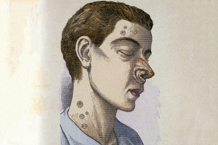 Man suffering from tertiary Syphilis. From Jules Rengade Le Grands Maux et les Grands Remedes, Paris, c1890.