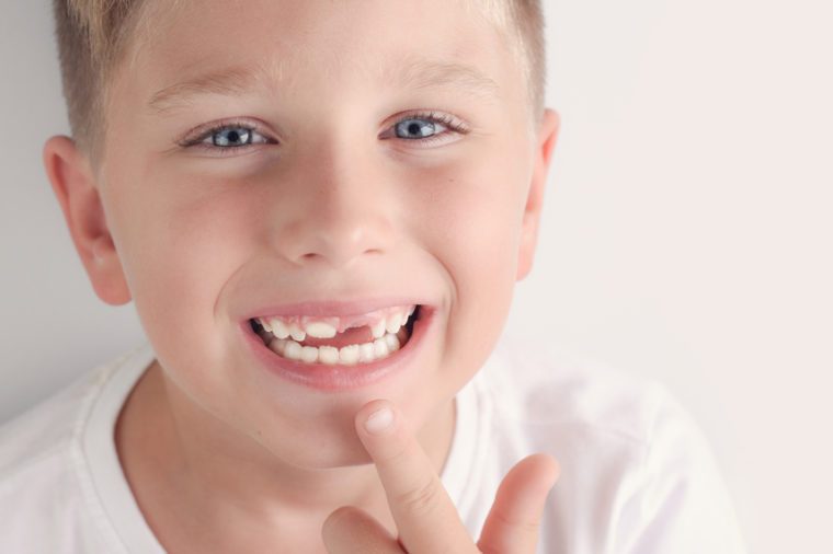 kid showing missing teeth