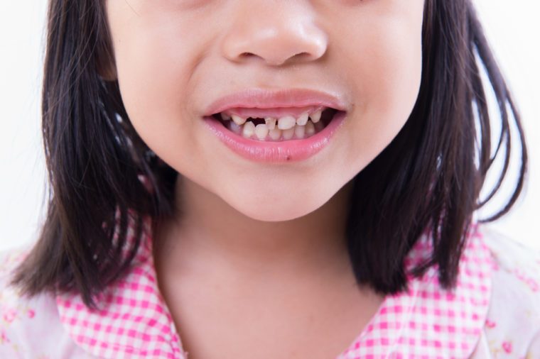 a child smile with missing teeth