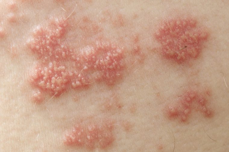Raised red bumps and blisters caused by shingles
