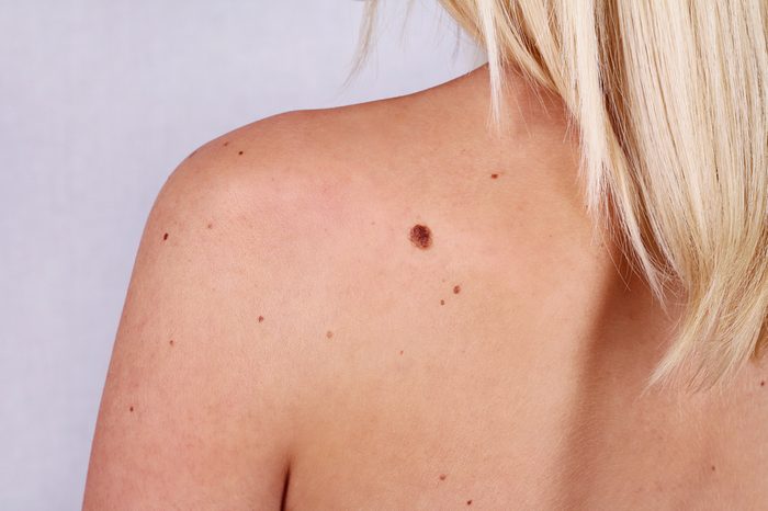 Young woman with at birthmark on her back, skin. Checking benign moles. Sun Exposure effect on skin, Health Effects of UV Radiation