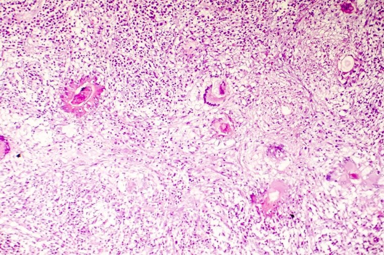 Liquefactive necrosis of the human brain, light photomicrograph showing loss of cell outlines, accumulation of cellular debris, macrophage infiltration. Developes in stroke, necrotising encephalitis